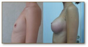 Breast enhance photo before and after