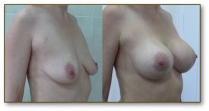 Breast enhancement procedures results before and after