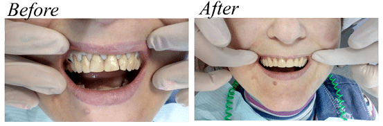 Cheap veneers before and after - Overseas Medical Ukraine photo